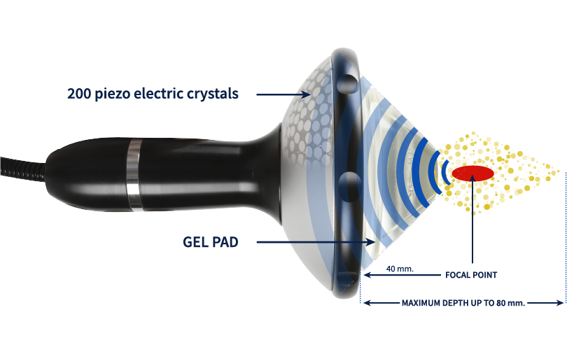 focused shock waves 21 Prapatsorn Medical เครื่องมือกายภาพบำบัด และตรวจปอด