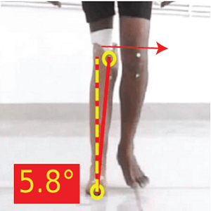 Excessive Medial thrust of Prostheses 2 Prapatsorn Medical เครื่องมือกายภาพบำบัด และตรวจปอด