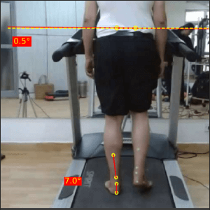 Left mid stance Post Parkinsons 1 Prapatsorn Medical เครื่องมือกายภาพบำบัด และตรวจปอด