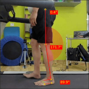 Left-terminal-stance_Parkinsons-1