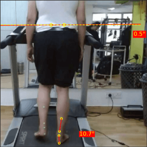 Right mid stance Post Parkinsons 2 Prapatsorn Medical เครื่องมือกายภาพบำบัด และตรวจปอด