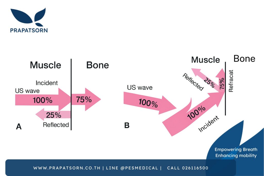 ultrasound wave Prapatsorn Medical เครื่องมือกายภาพบำบัด และตรวจปอด