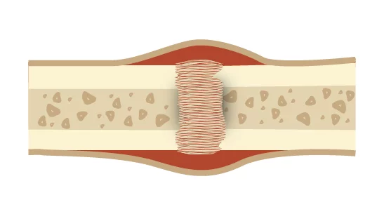 faza zrastania kosci Prapatsorn Medical เครื่องมือกายภาพบำบัด และตรวจปอด