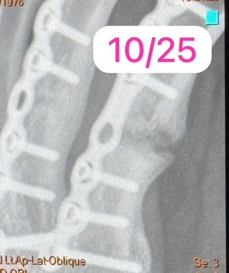 Lipus Therapy กรณีศึกษา ปัญหากระดูกติดช้า 3 S 26271749 Prapatsorn Medical เครื่องมือกายภาพบำบัด และตรวจปอด